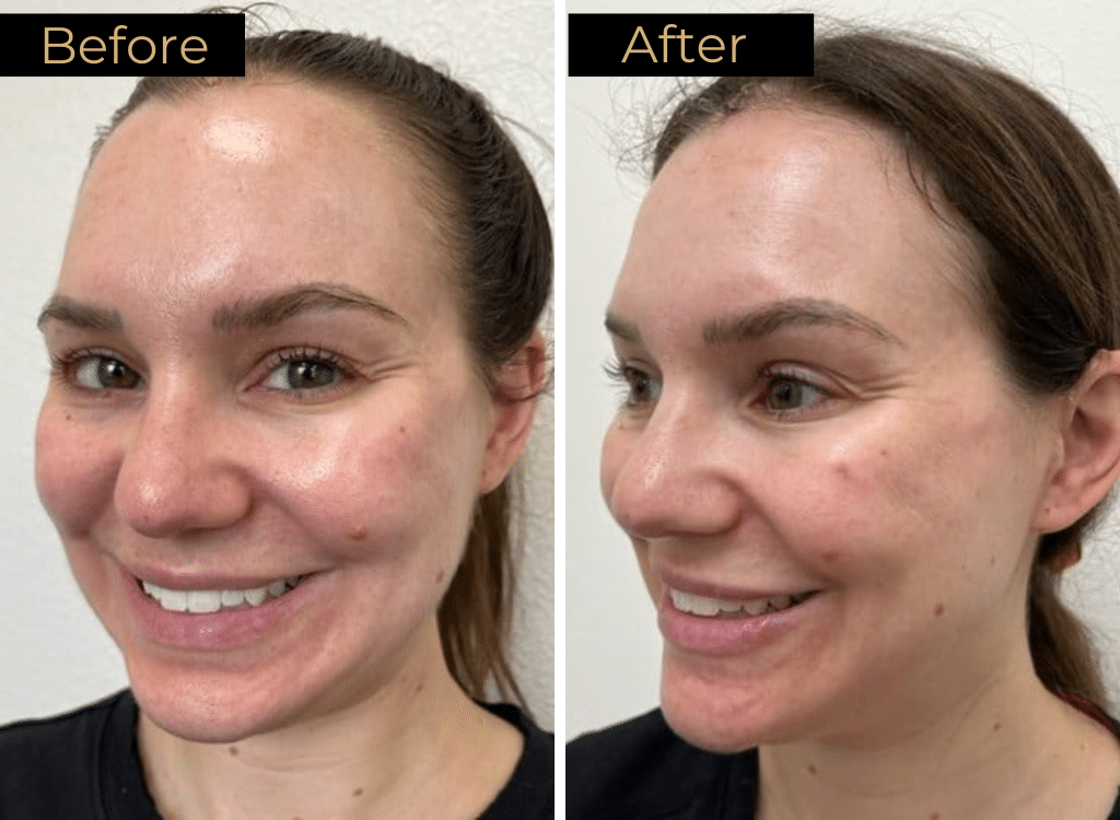 Dermal Fillers Before & After Images | LOURE Aesthetics | Waunakee, WI