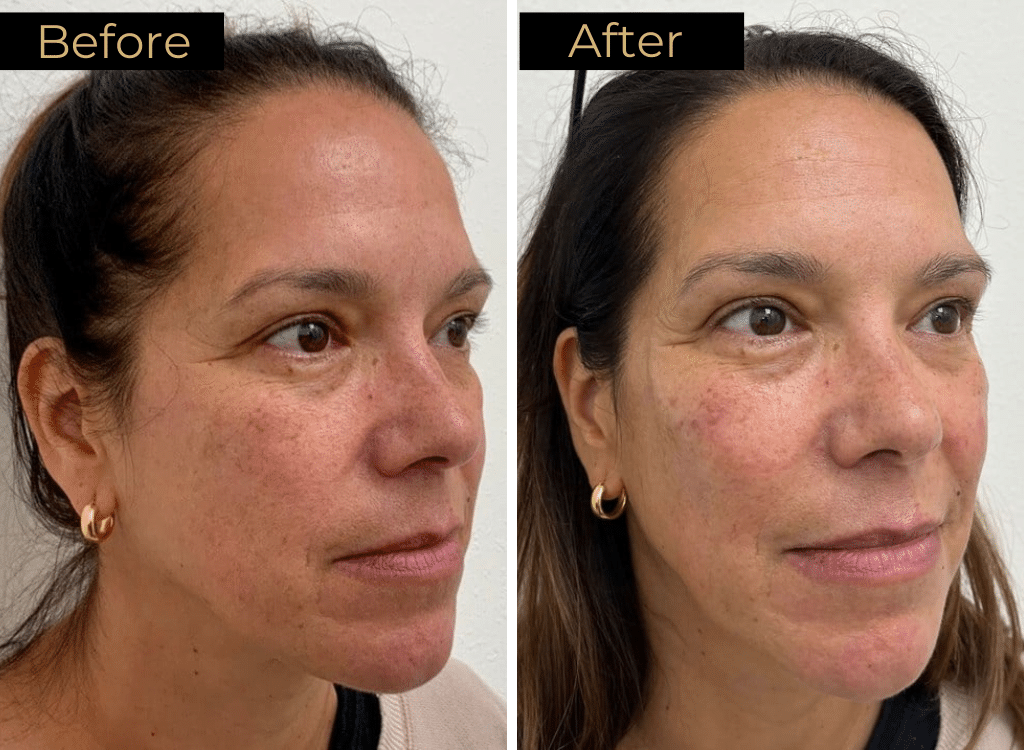 Dermal Fillers Before & After Images | LOURE Aesthetics | Waunakee, WI