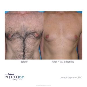 Laser Hair Removal Before & After Image | LOURE Aesthetics | Waunakee, WI