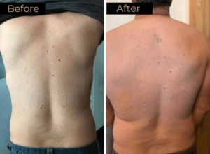 Laser Hair Removal Before & After Images | LOURE Aesthetics | Waunakee, WI