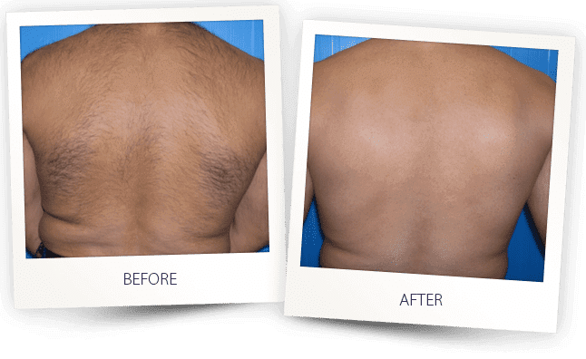 Hair Removal Before & After Image | LOURE Aesthetics | Waunakee, WI