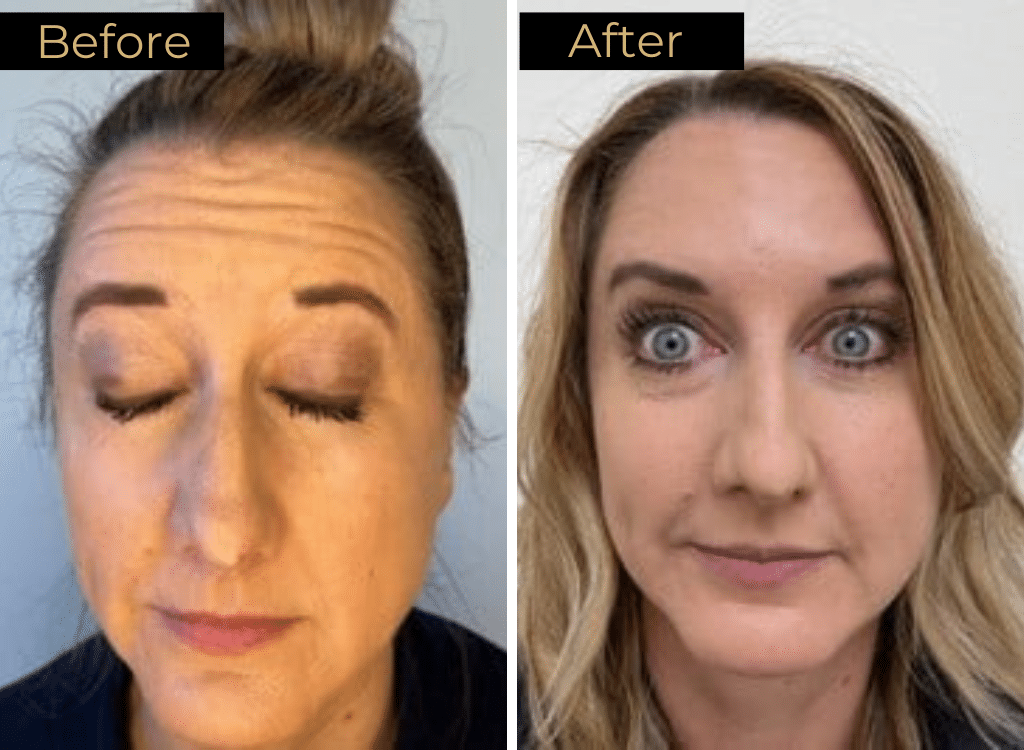 Wrinkle Relaxers Before & After Image | LOURE Aesthetics | Waunakee, WI