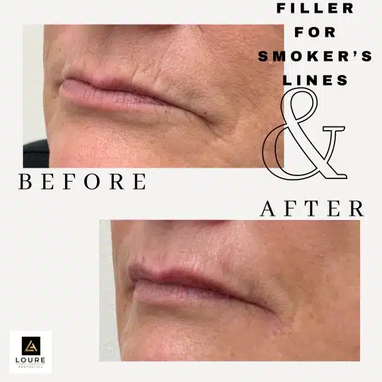 dermal filler gallery a