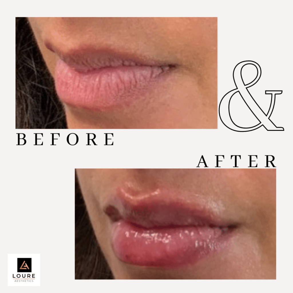 Lip Fillers Before and After | Waunakee, WI