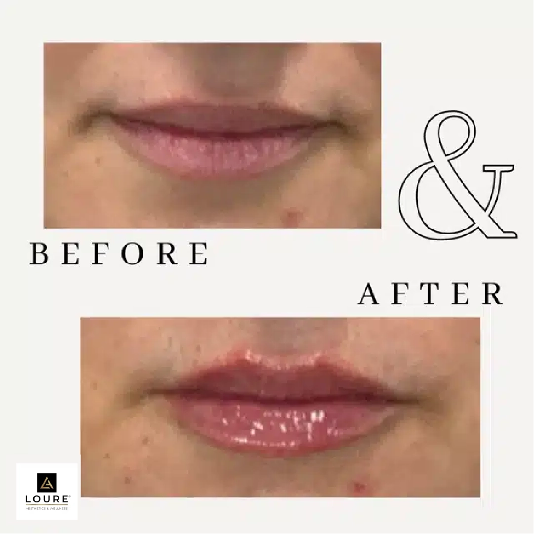 Derma Filler Gallery a