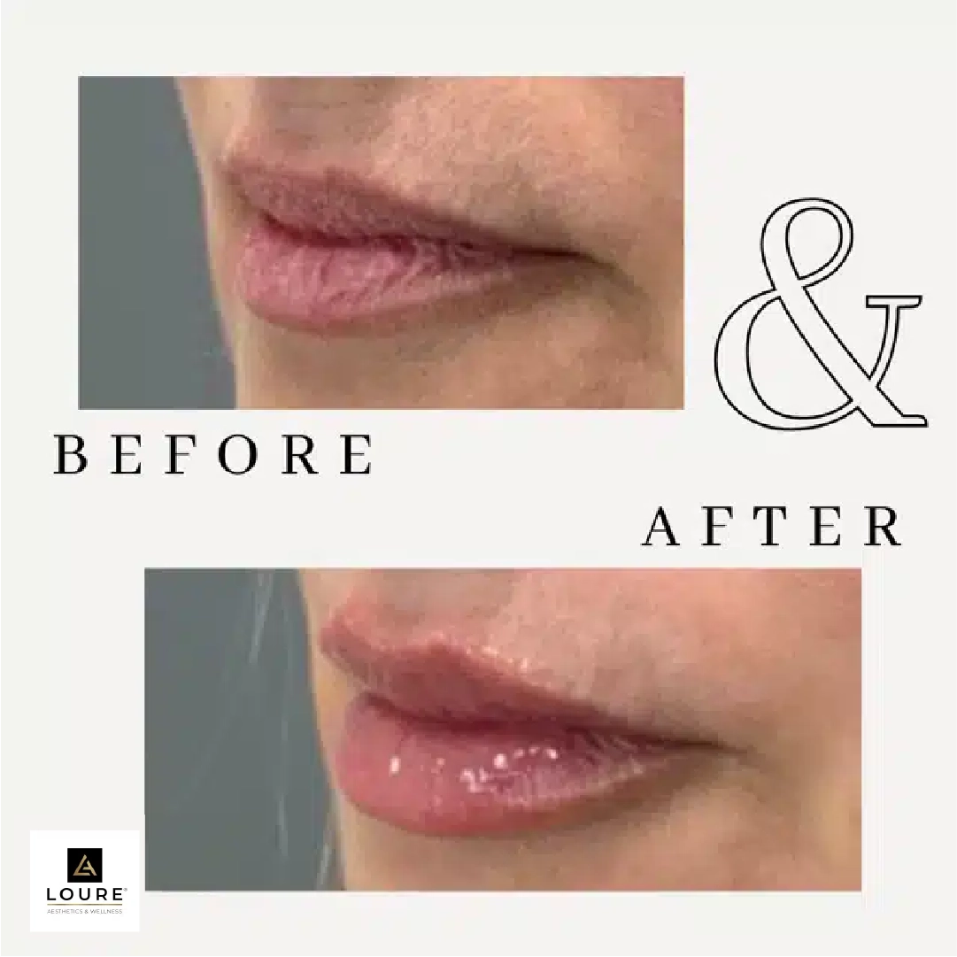 Derma Filler Gallery b