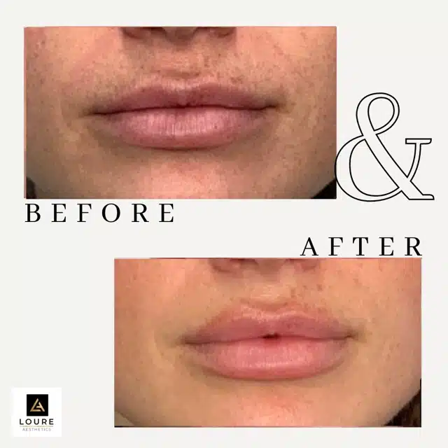 Lip Filler Before and After.zip 22