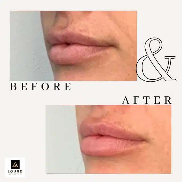 Lip Filler Before and After.zip 23