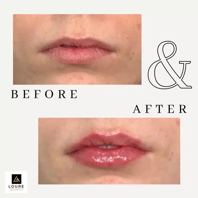 Lip Filler Before and After.zip 24