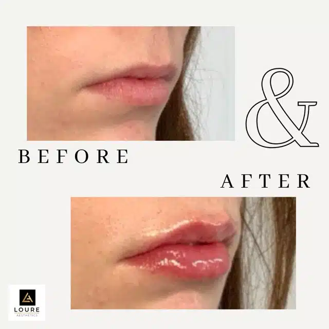 Lip Filler Before and After.zip 25