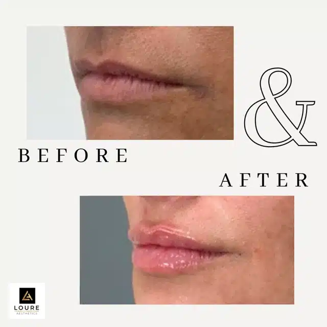 Lip Filler Before and After.zip 28