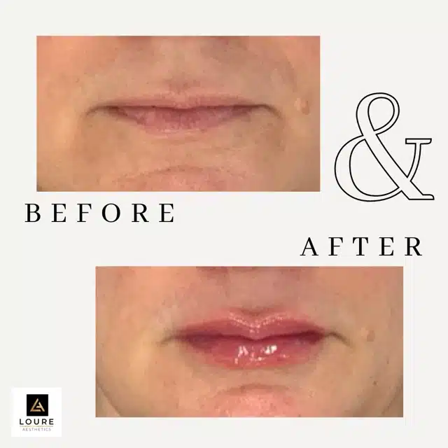 Lip Filler Before and After.zip 32