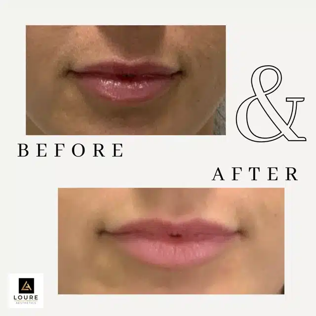 Lip Filler Before and After.zip 33