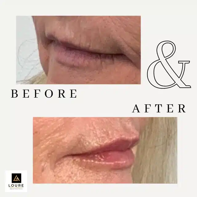 Lip Filler Before and After.zip 35