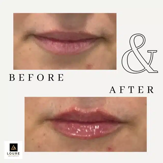 Lip Filler Before and After.zip 36