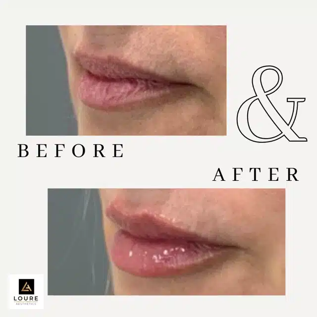 Lip Filler Before and After.zip 38