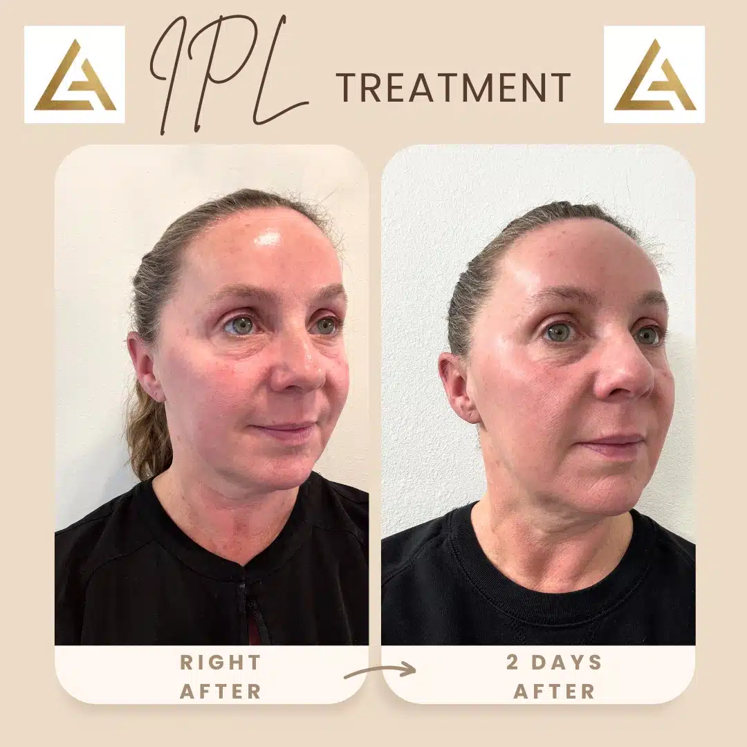 loureaesthetics IPL photofacial before and after aa