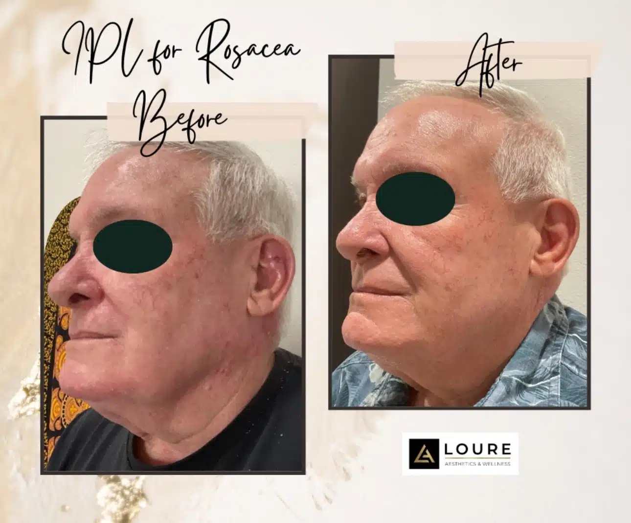 IPL Photofacial 16 IMG_3939