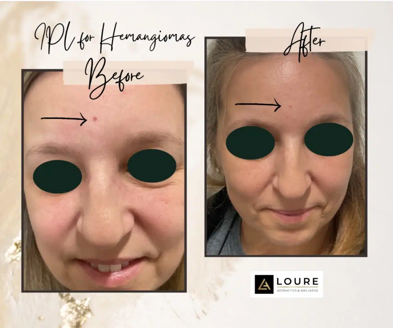 IPL Photofacial 15 IMG_3940