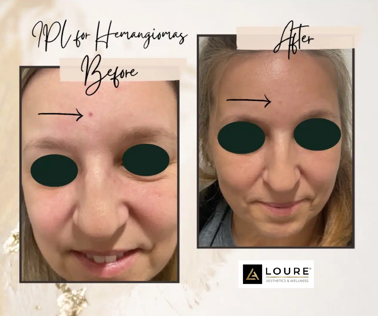 IPL Photofacial 19 Image edit-2