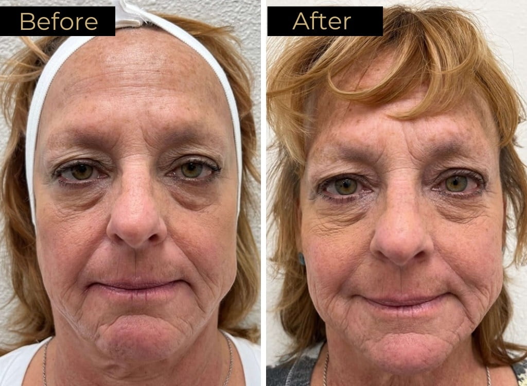 Loure Aesthetics Dermal Fillers Before and After ggg