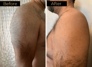Laser Hair Removal Before & After Images | LOURE Aesthetics | Waunakee, WI