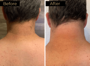 Laser Hair Removal Before & After Images | LOURE Aesthetics | Waunakee, WI