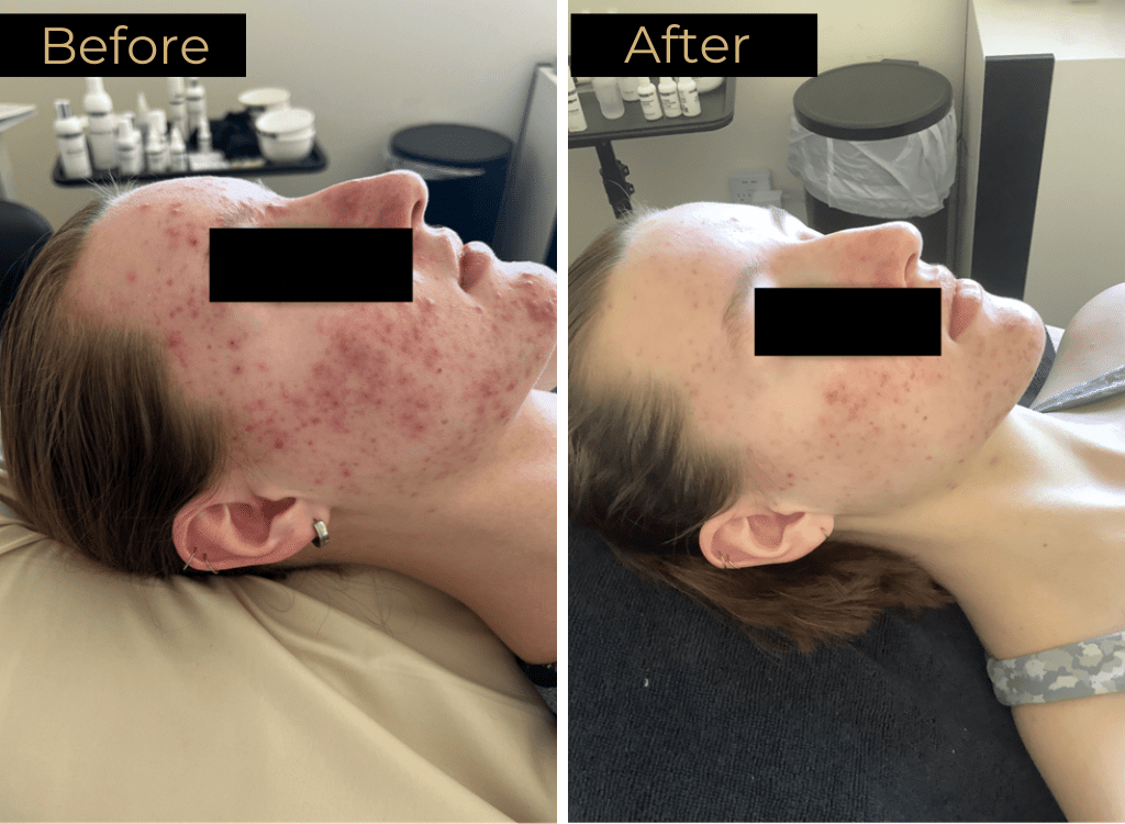 Skin Rejuvenation Before & After Images | LOURE Aesthetics | Waunakee, WI