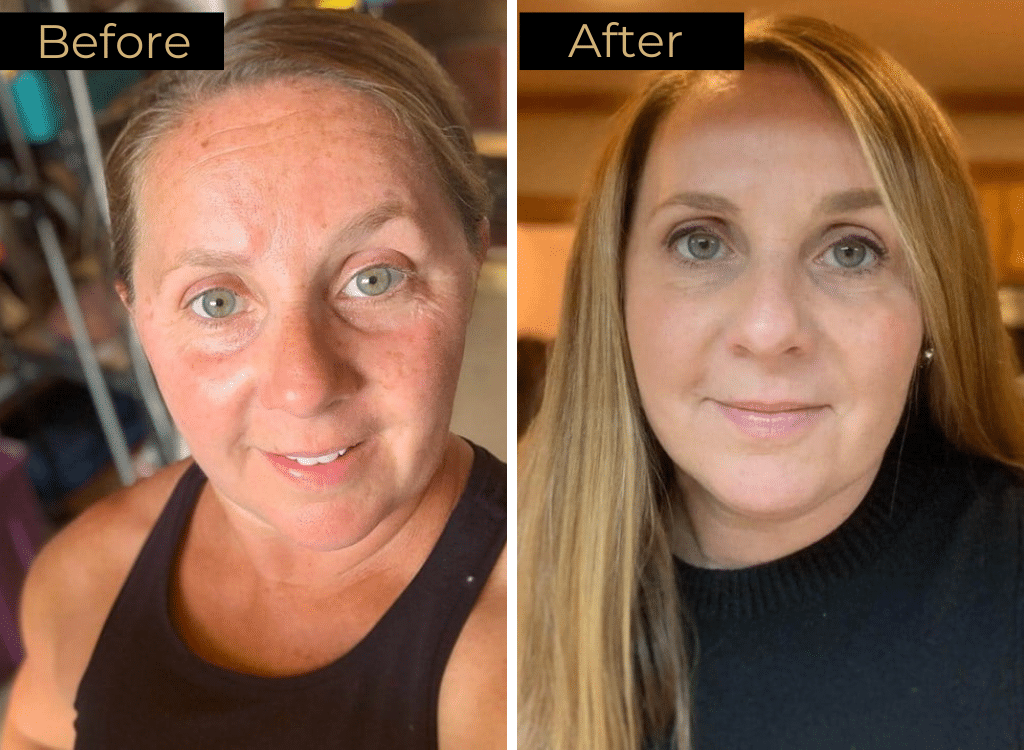 Skin Rejuvenation Before & After Images | LOURE Aesthetics | Waunakee, WI