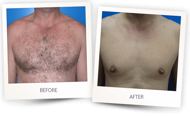 Hair Removal Before & After Image | LOURE Aesthetics | Waunakee, WI
