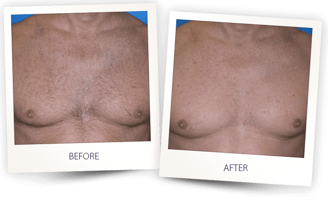 Hair Removal Before & After Image | LOURE Aesthetics | Waunakee, WI