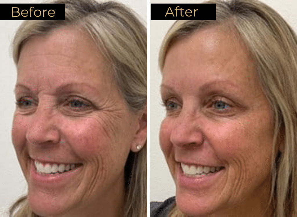 Wrinkle Relaxers Before & After | LOURE Aesthetics | Waunakee, WI