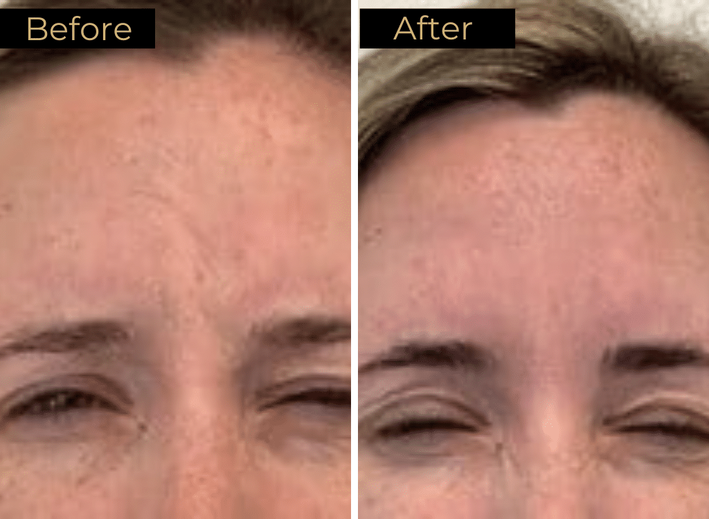Wrinkle Relaxers Before & After Images | LOURE Aesthetics | Waunakee, WI