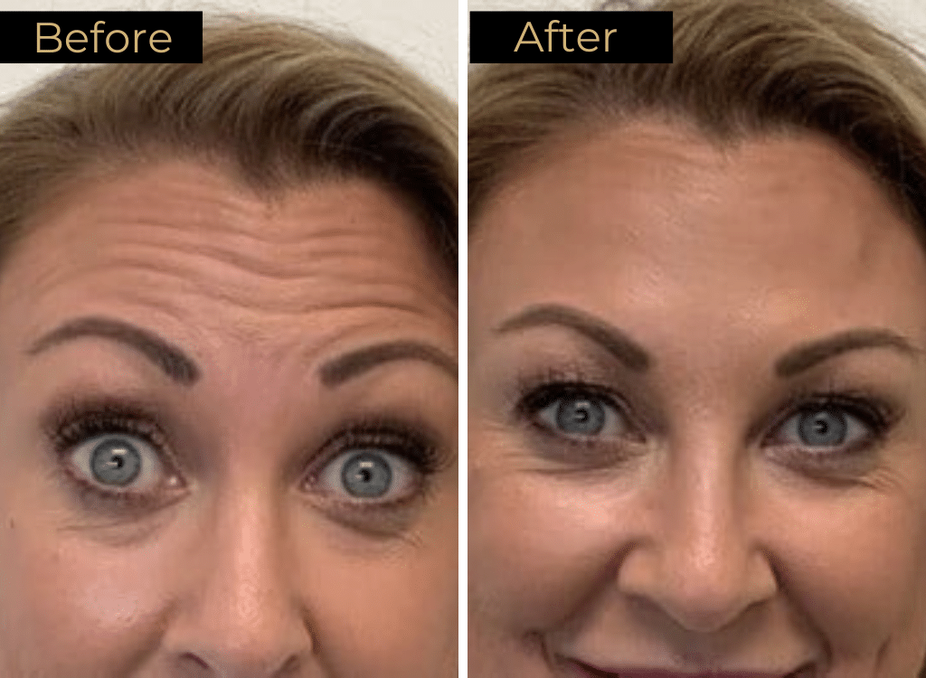 Botox and Dysport 23 Wrinkle Relaxers Before & After Images | LOURE Aesthetics | Waunakee, WI