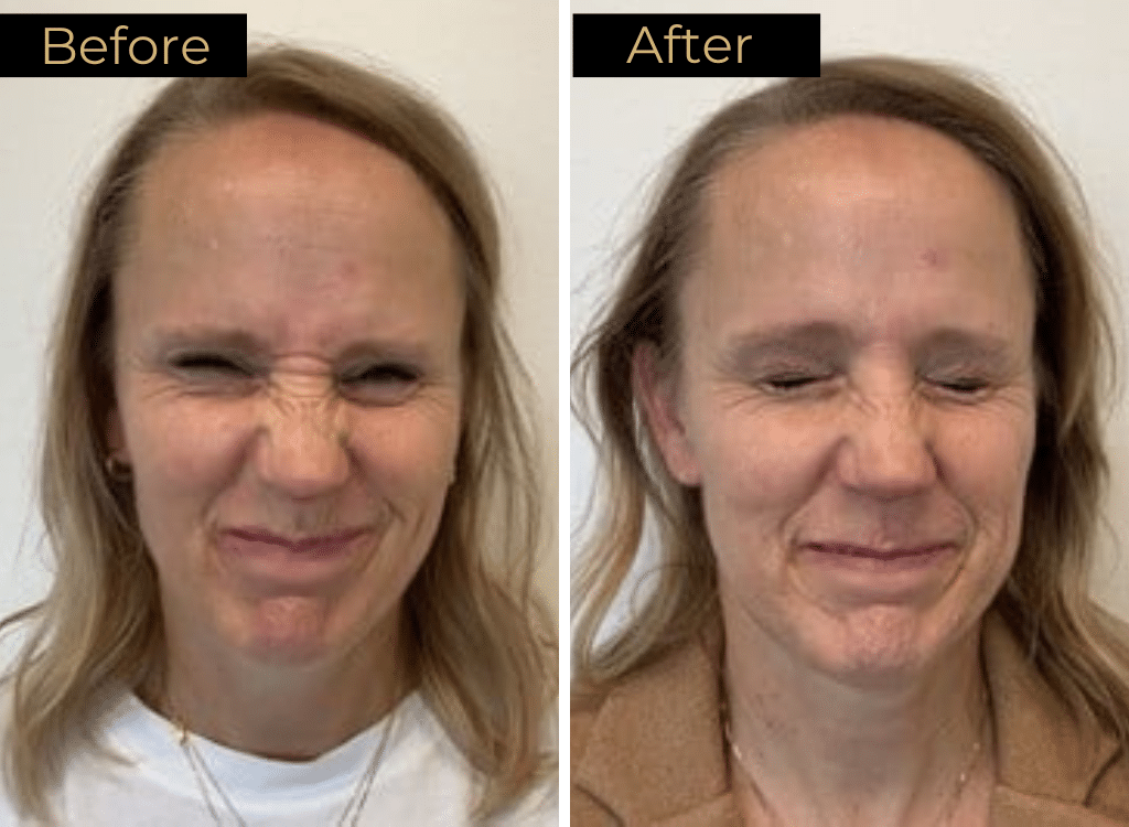 Wrinkle Relaxers Before & After Images | LOURE Aesthetics | Waunakee, WI