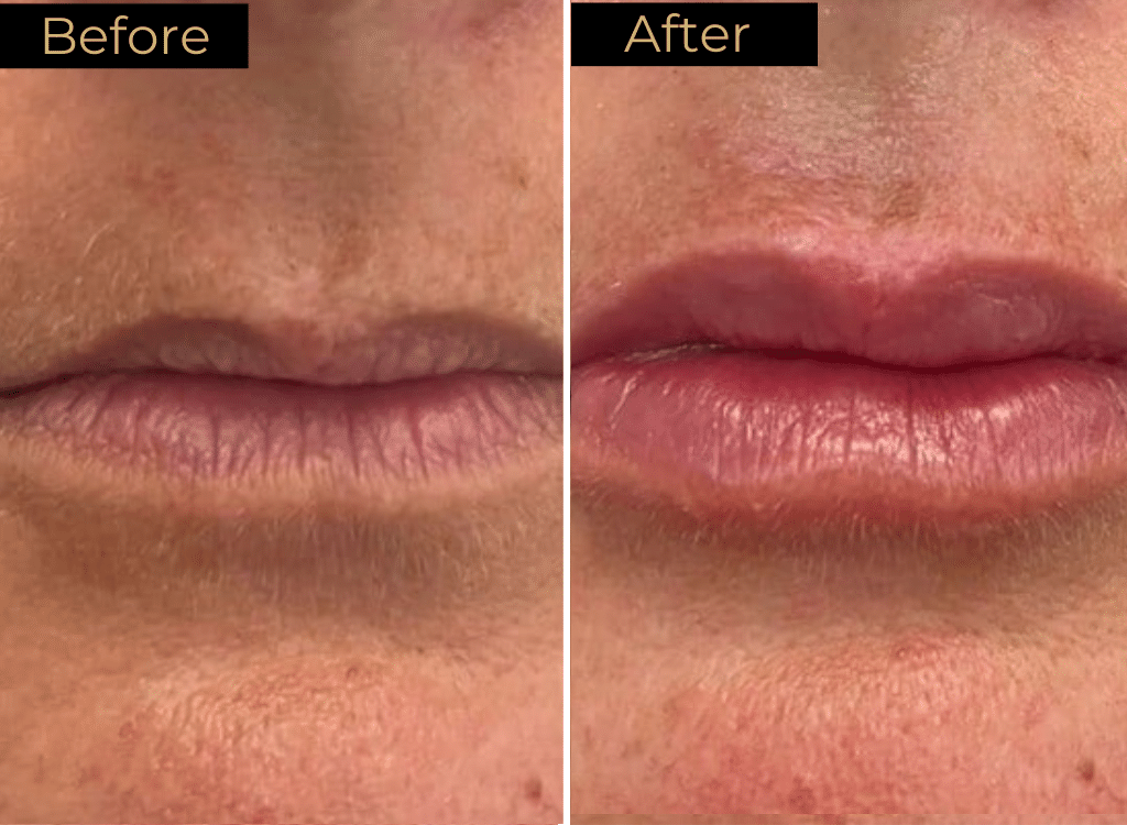 Dermal Fillers Before & After Image | LOURE Aesthetics | Waunakee, WI