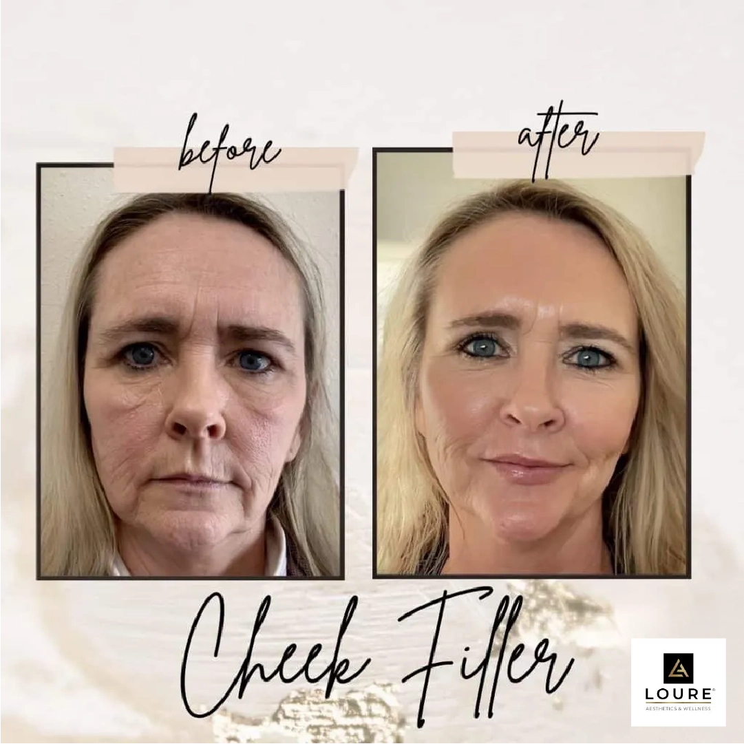 cheek filler
