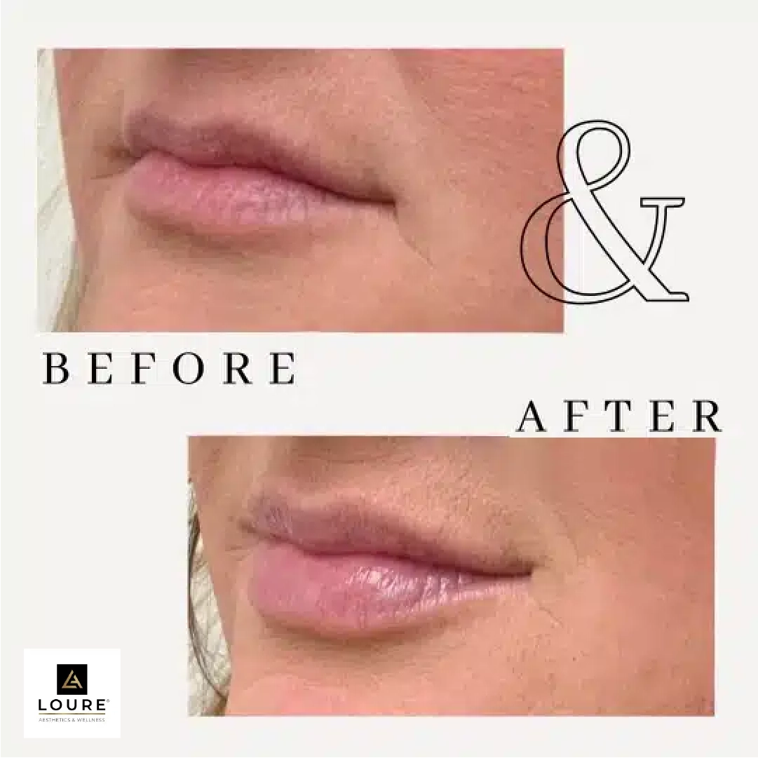 Before and After filler