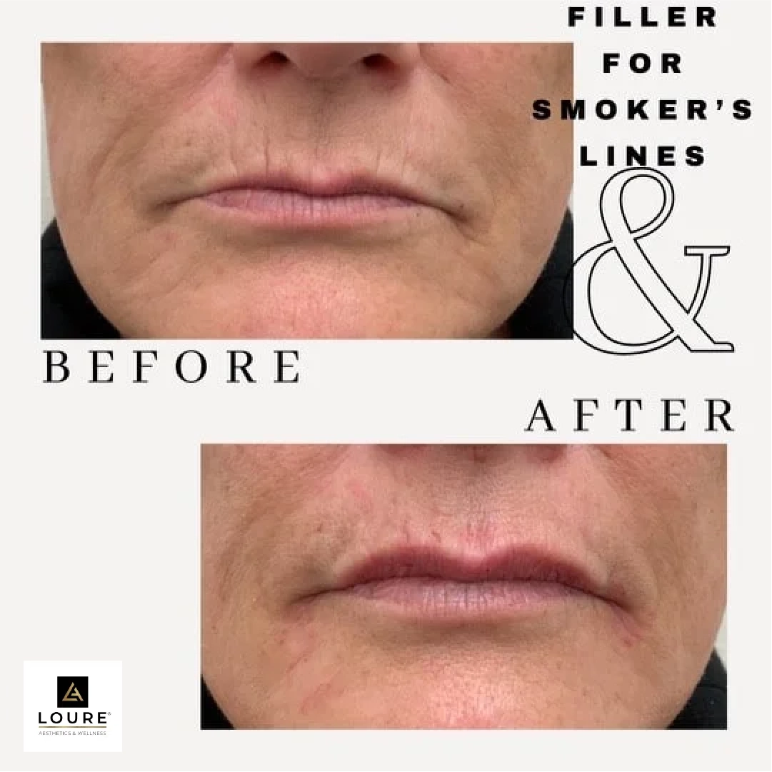 Filler For Smokers Lines