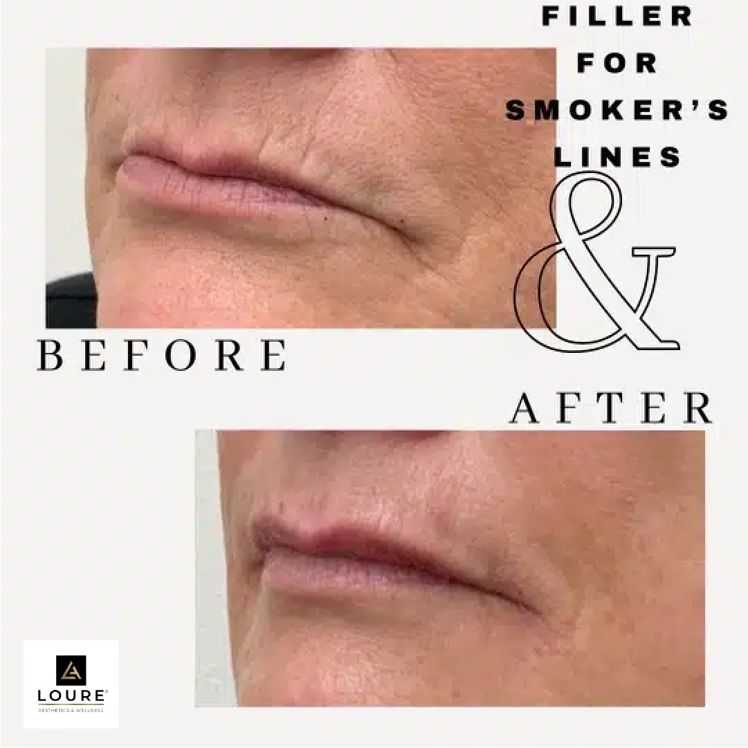 Filler For Smokers lines
