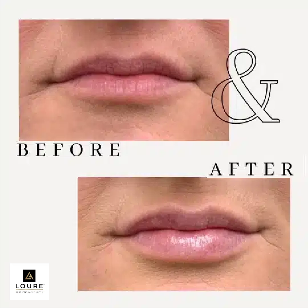 Before and After Lip Filler