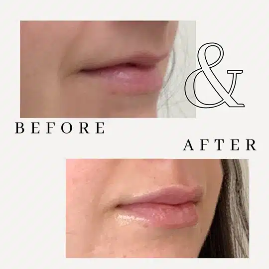 dermal filler gallery d