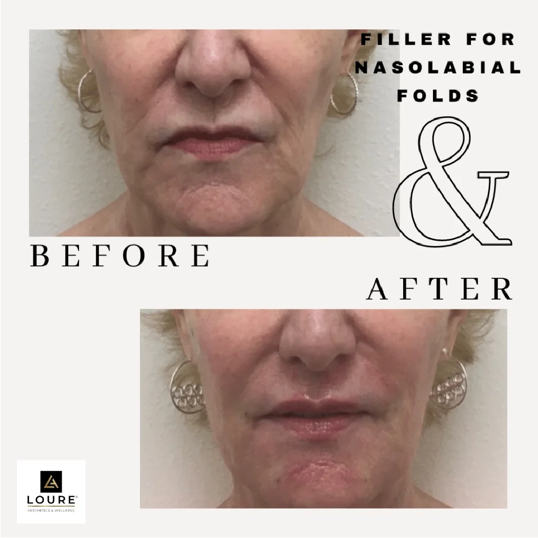 Filler for Nasolabial