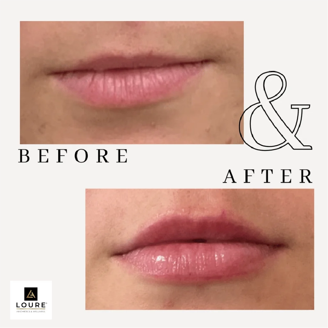 DERMA FILLER