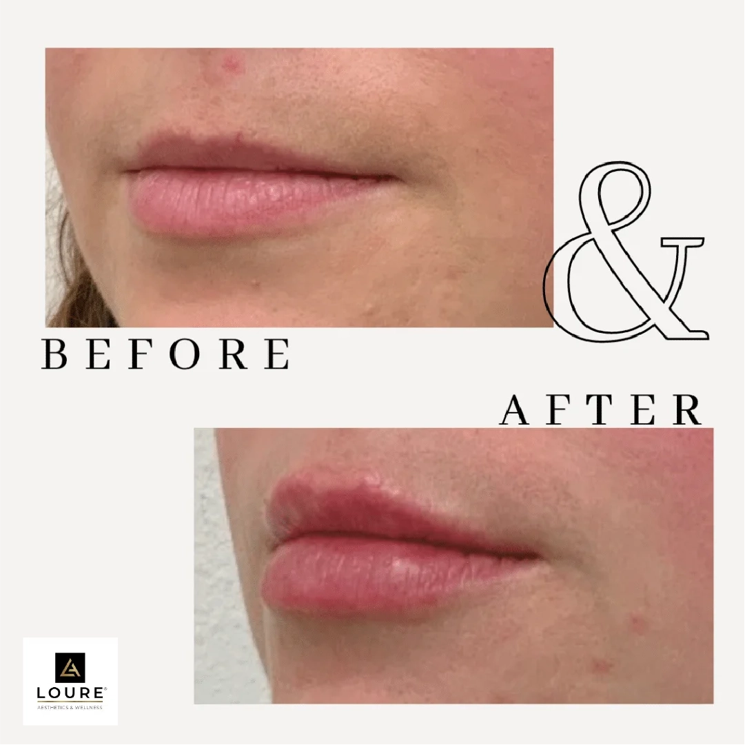 Before and After