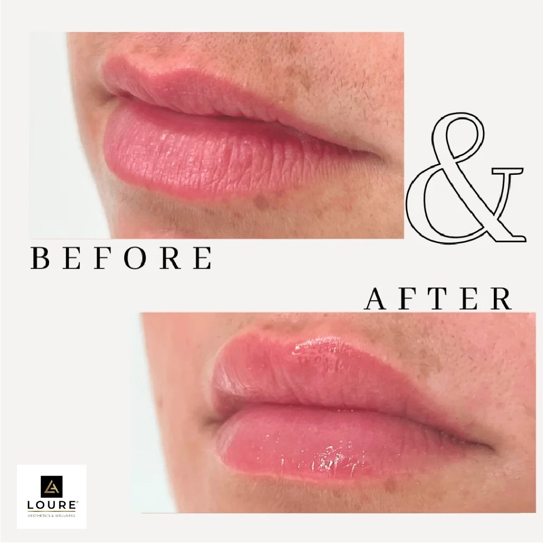 Dermal fillers in Waunakee, WI