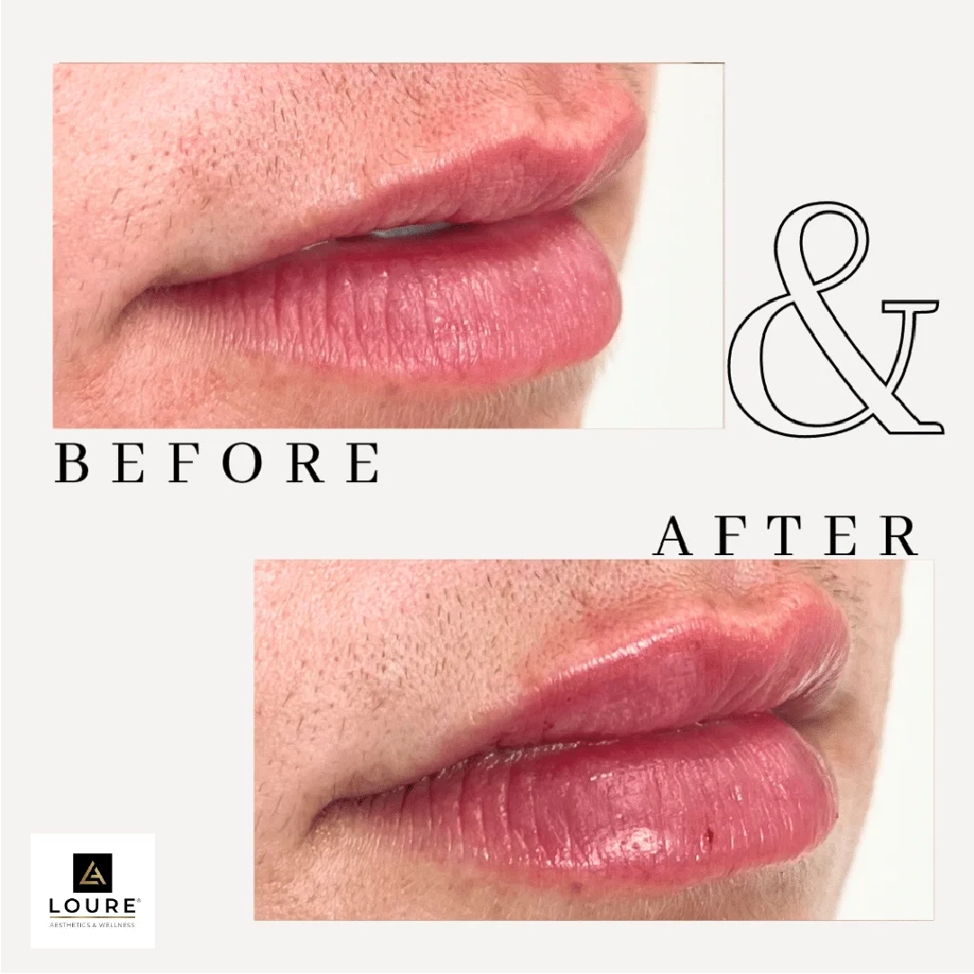 Lip Treatment
