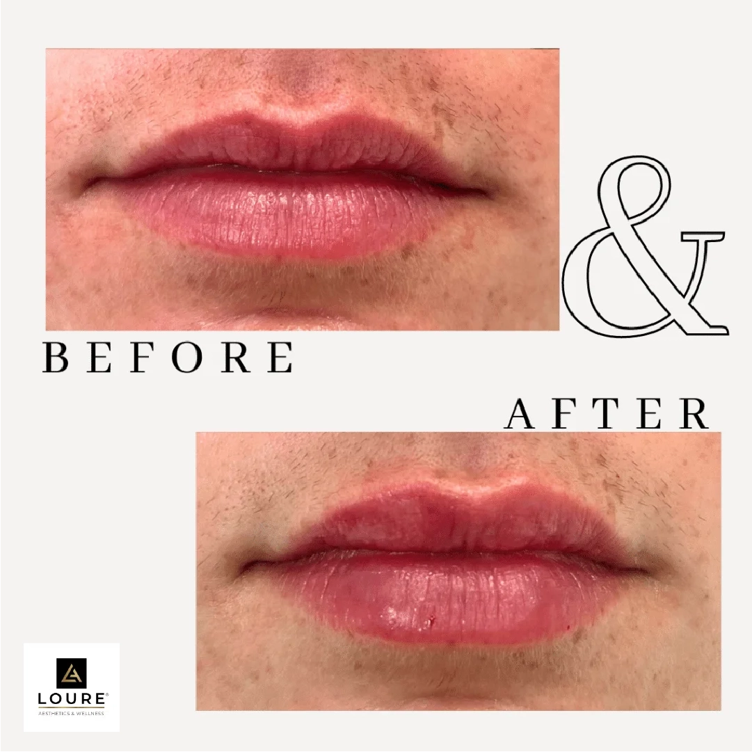 Before and after Fillers Treatment