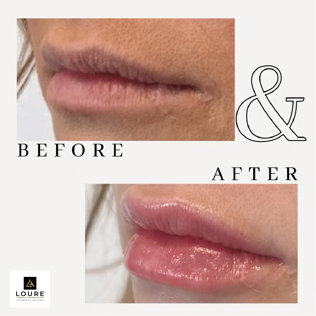 Derma Filler in Waunakee, WI