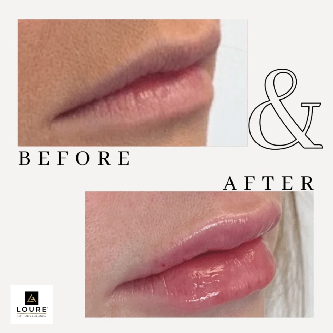 Before and After Dermal filler